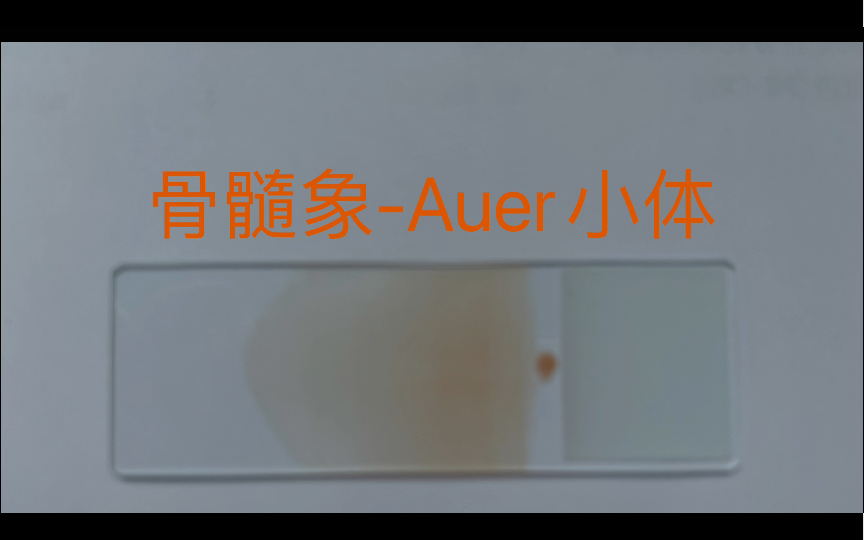 骨髓象Auer小体哔哩哔哩bilibili