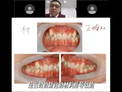 Descargar video: 4-如何打开咬合，矫治深覆𬌗