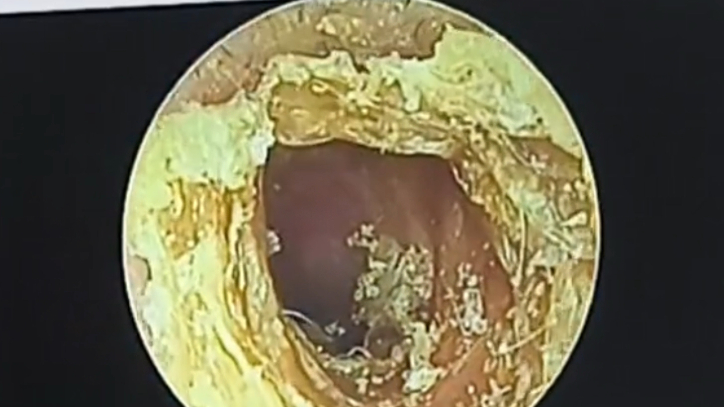 耳屎放大1000倍的图片图片