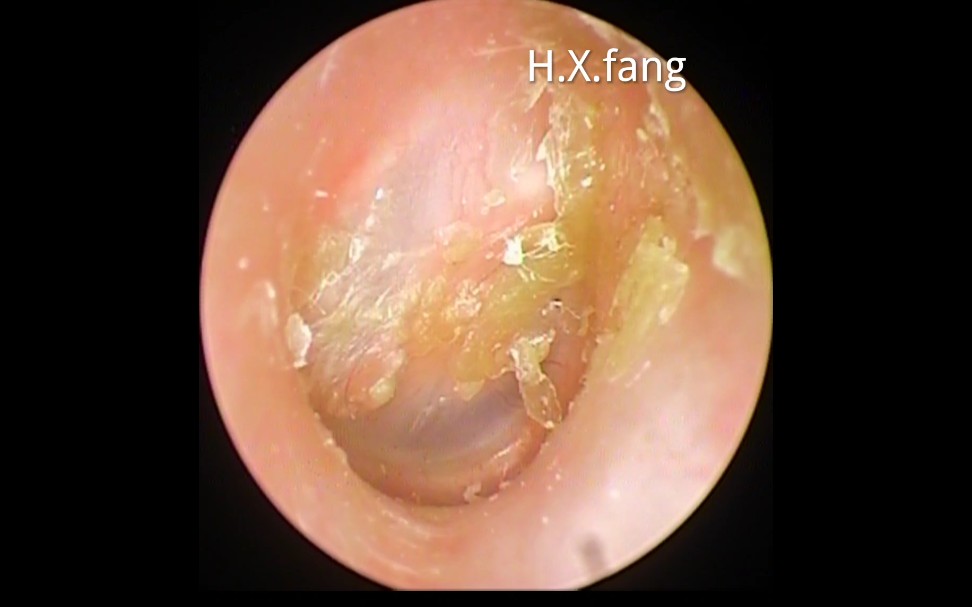专业可视采耳死皮和脓性分泌物清理Dead skin and purulent discharge Cleansing20240228.03哔哩哔哩bilibili