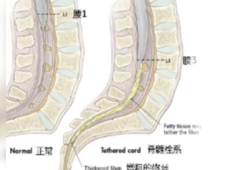 脊髓栓系综合征影像学表