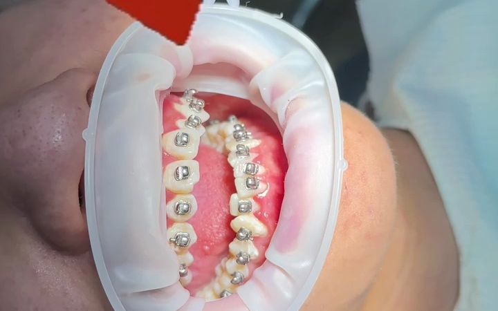 牙齿矫正,今天戴牙套的小哥哥选择球形托槽,舒适度满分#天使口腔