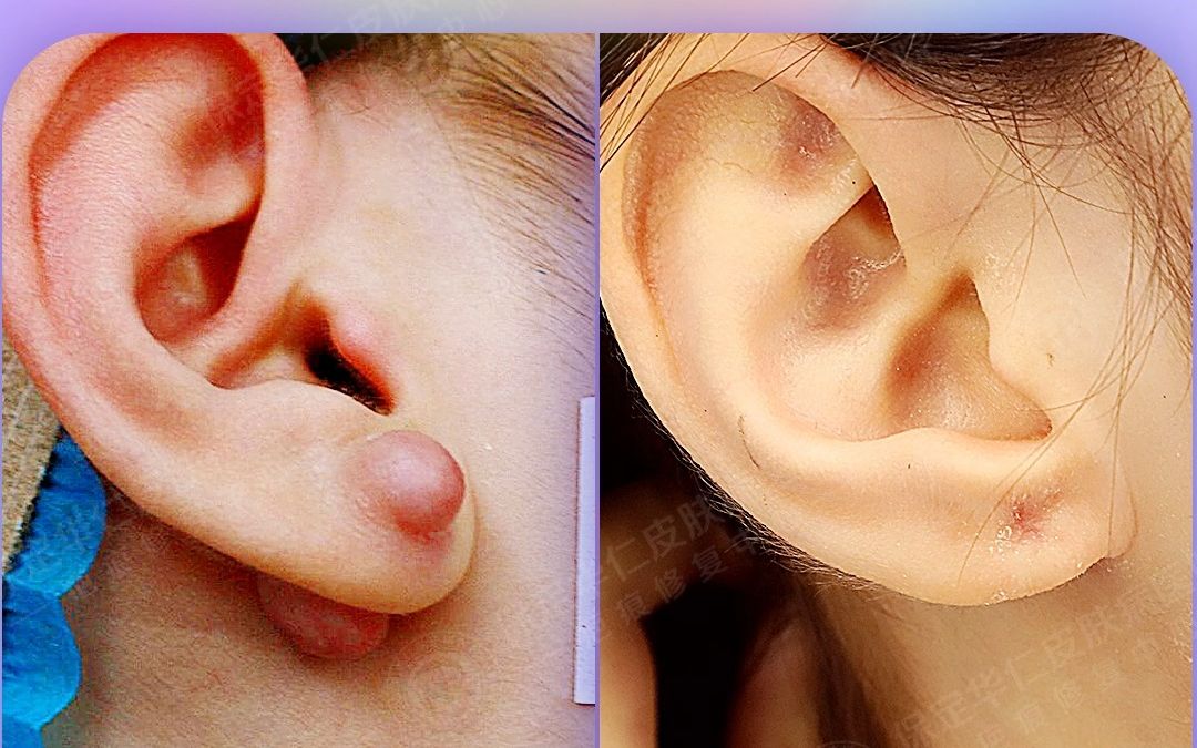 耳朵瘢痕疙瘩耳洞图片
