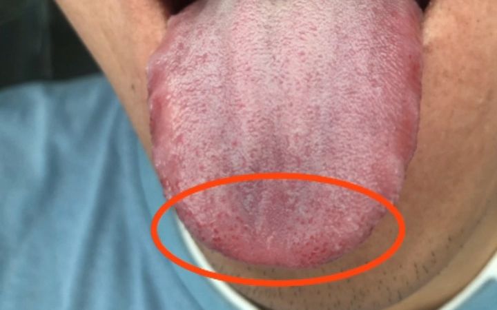 肝硬化舌苔图片图片