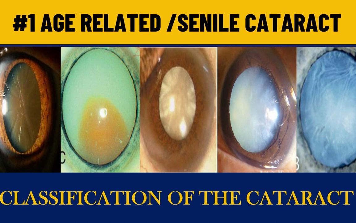 Age related Cataract|Senile cataract stages  年龄相关性白内障|老年性白内障分期哔哩哔哩bilibili