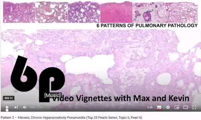 fibrosischronichypersensitivitypneumonitis慢性过敏性肺炎maxand