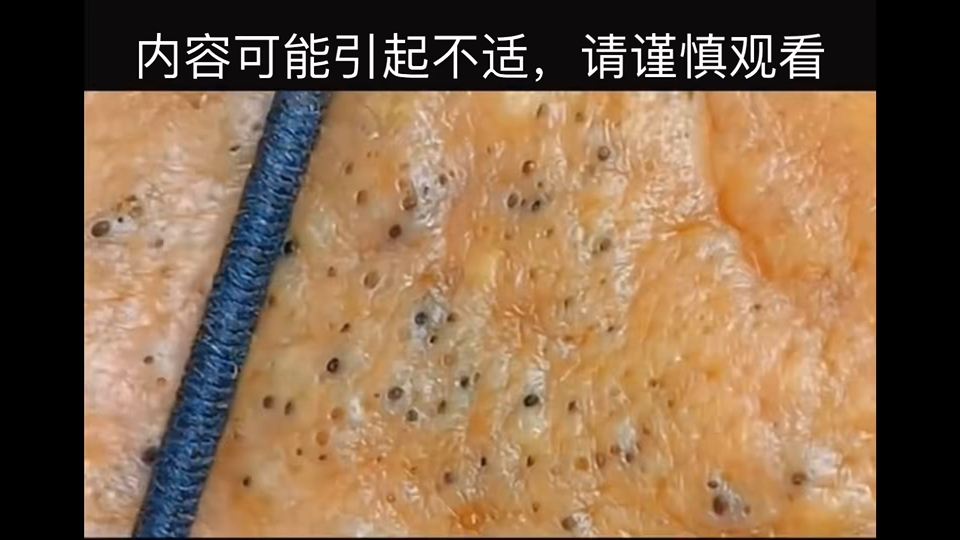 几十年的老黑头,挤完白八个度