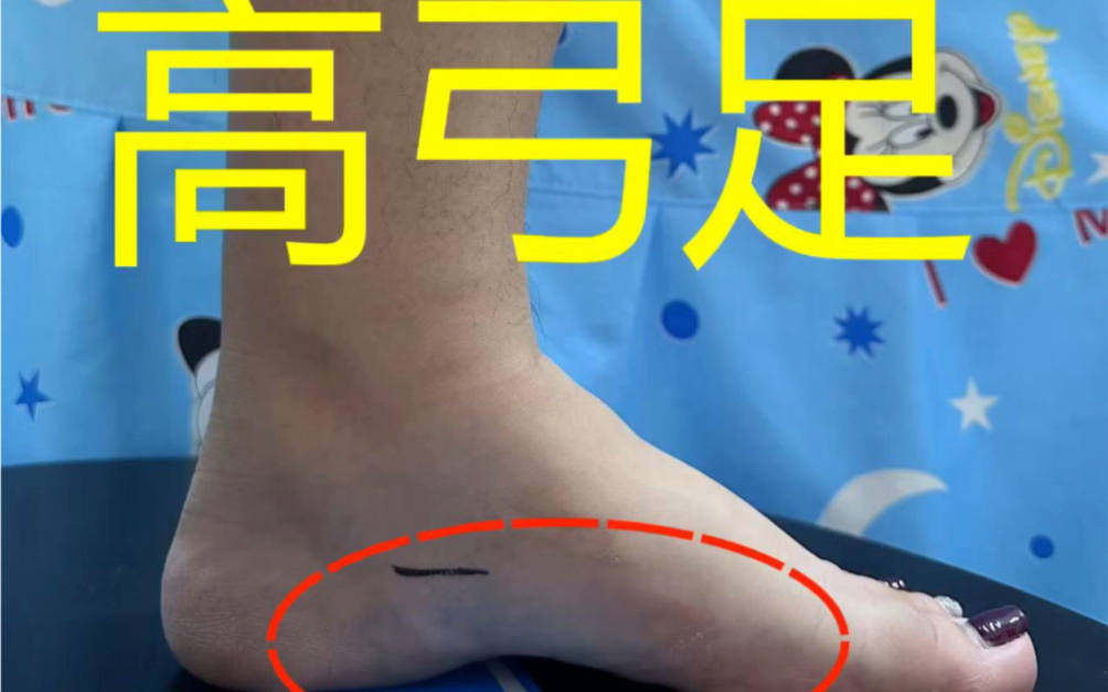 成人女性高弓足,足内翻,伴随足部疼痛