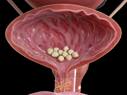 膀胱结石是什么样的?哔哩哔哩bilibili