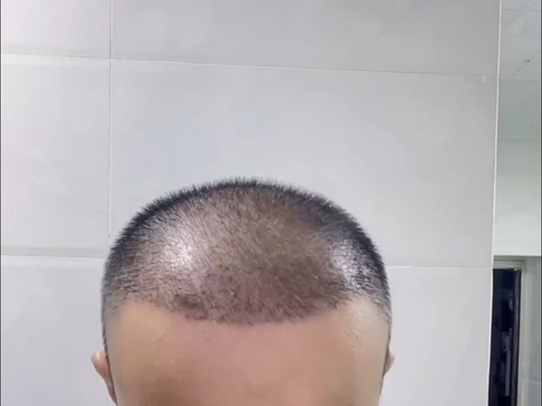 真实植发分享更新:第21天,脱落期心态一定平和!不要焦虑,继续更新!