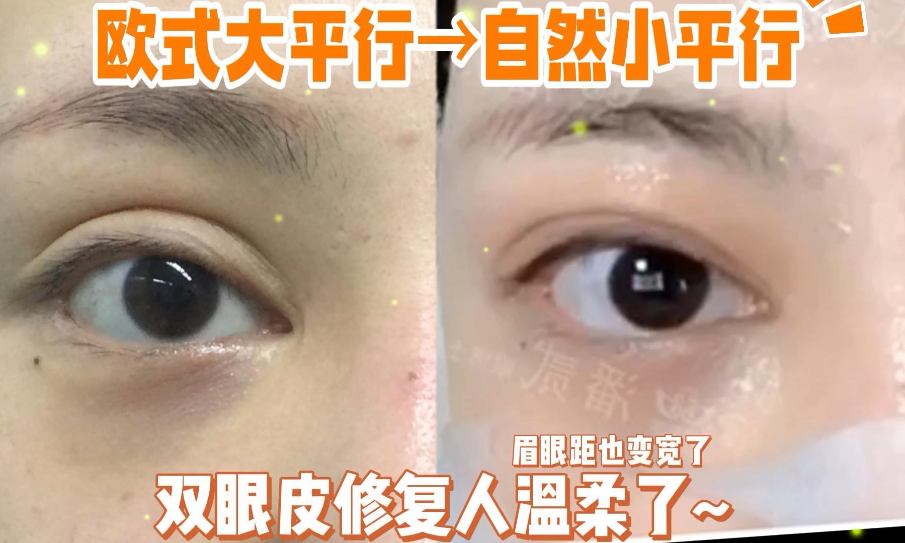 欧式大平行改自然小平行,双眼皮修复后人都温柔了~再见假大宽深