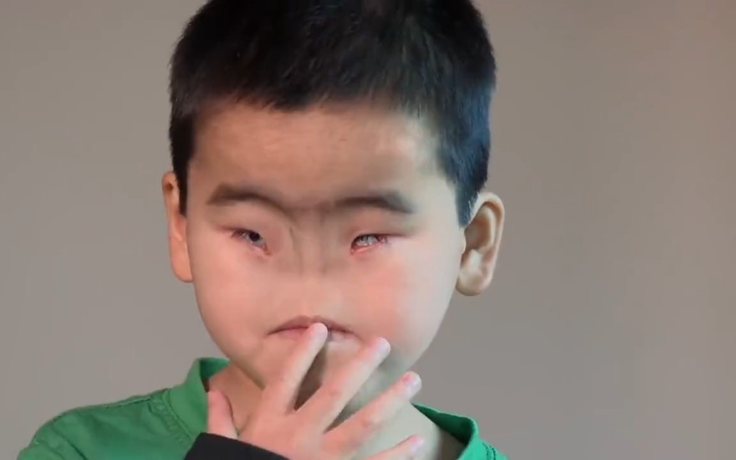 没有鼻子的男孩,出生后被遗弃孤儿院,之后被国外夫妻收养,遇到好心人