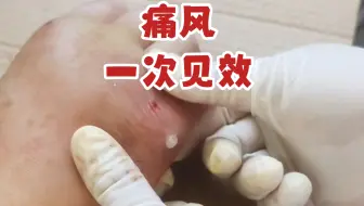 痛风！一次见效！