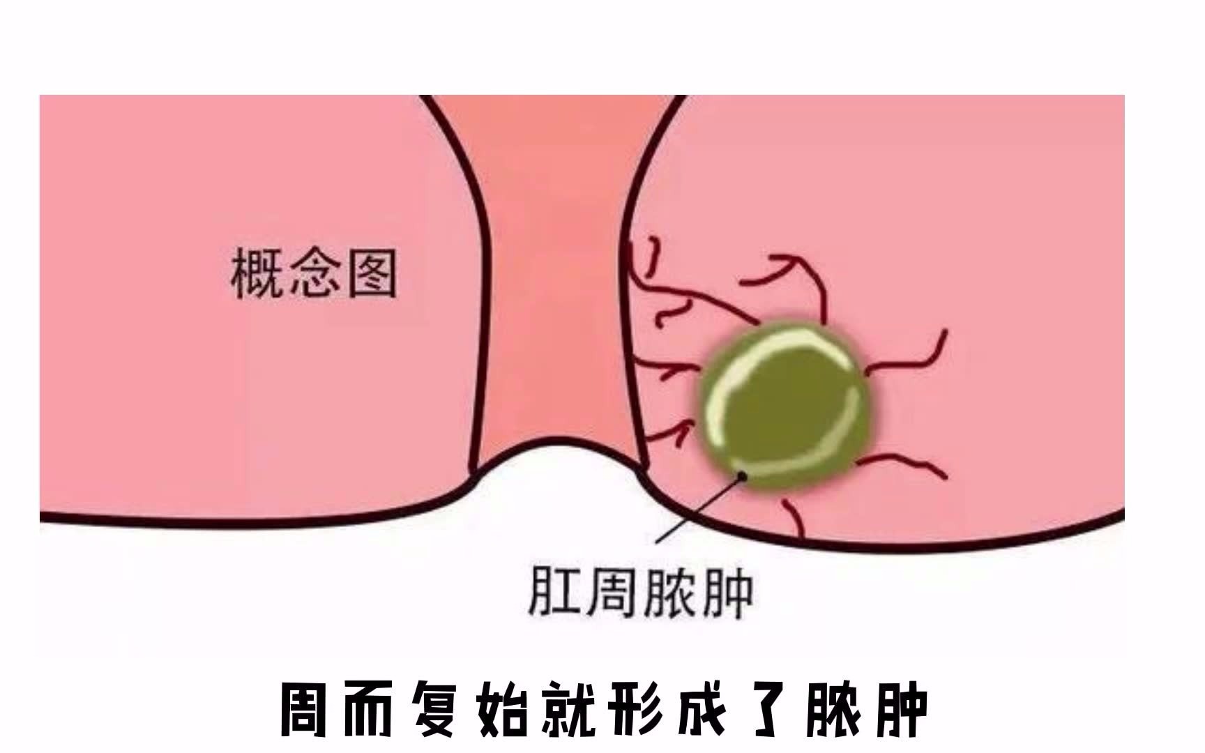 女性肛周脓肿症状图片