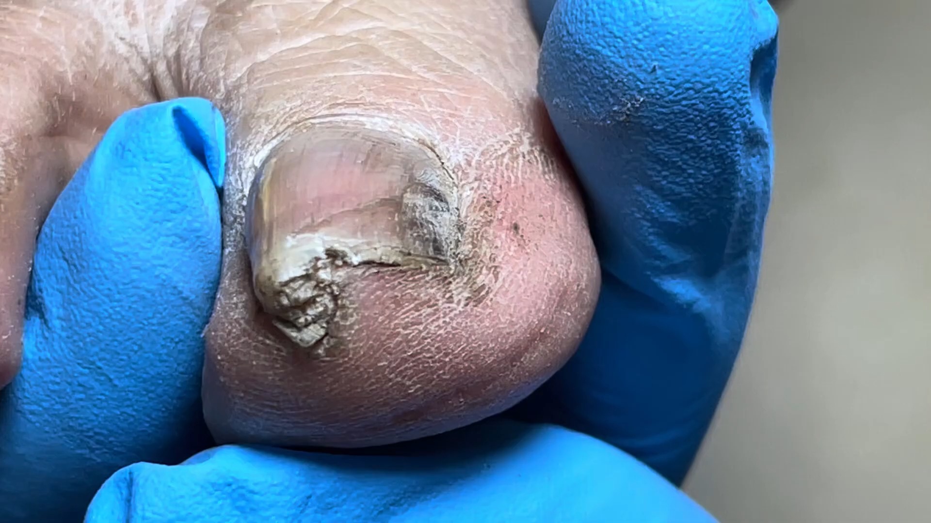 脚趾甲向内弯曲的程度有点严重