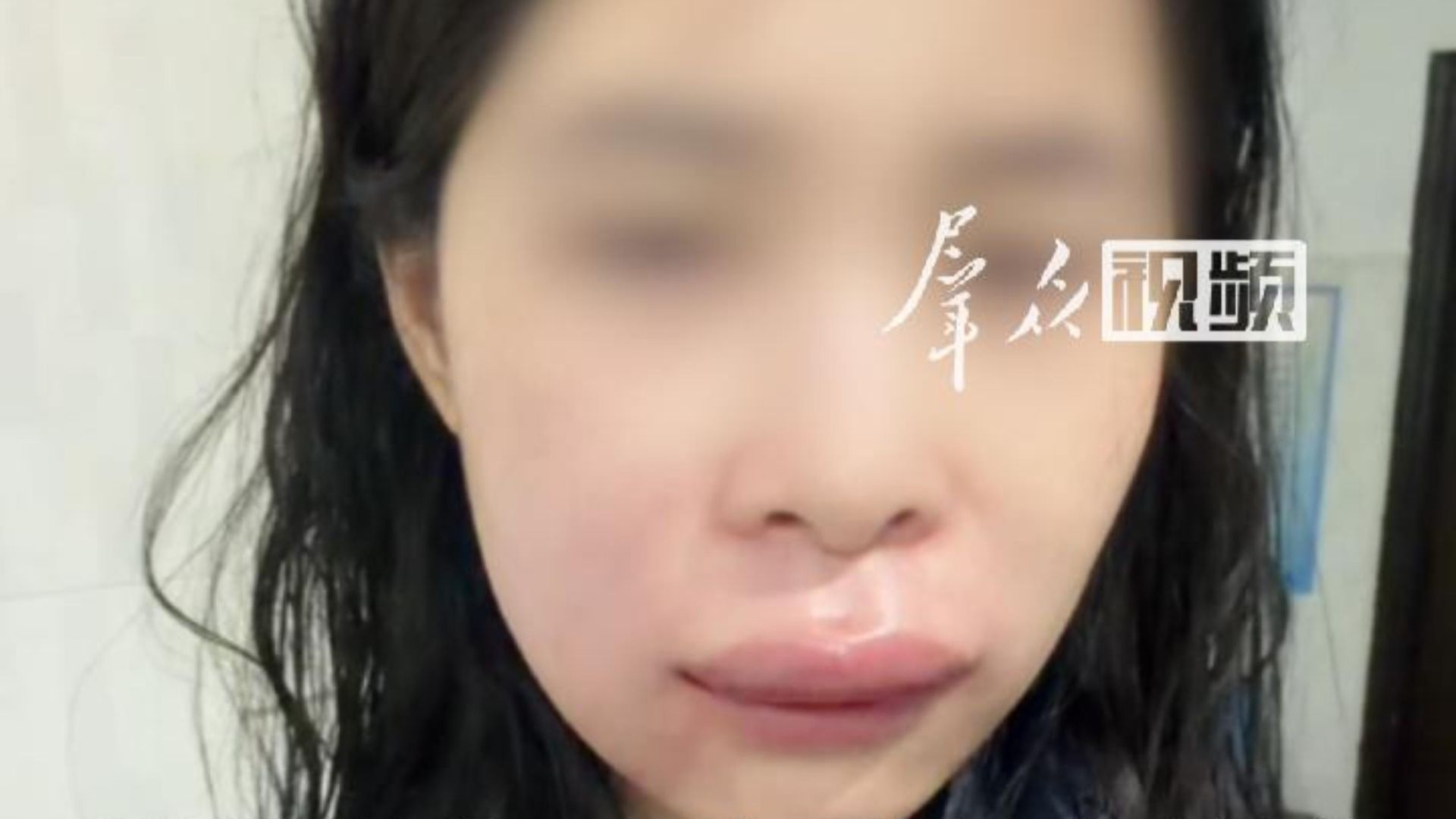新娘婚礼前一天被马蜂蜇成香肠嘴，随即前往医院输液治疗，肿胀得到一定缓解。