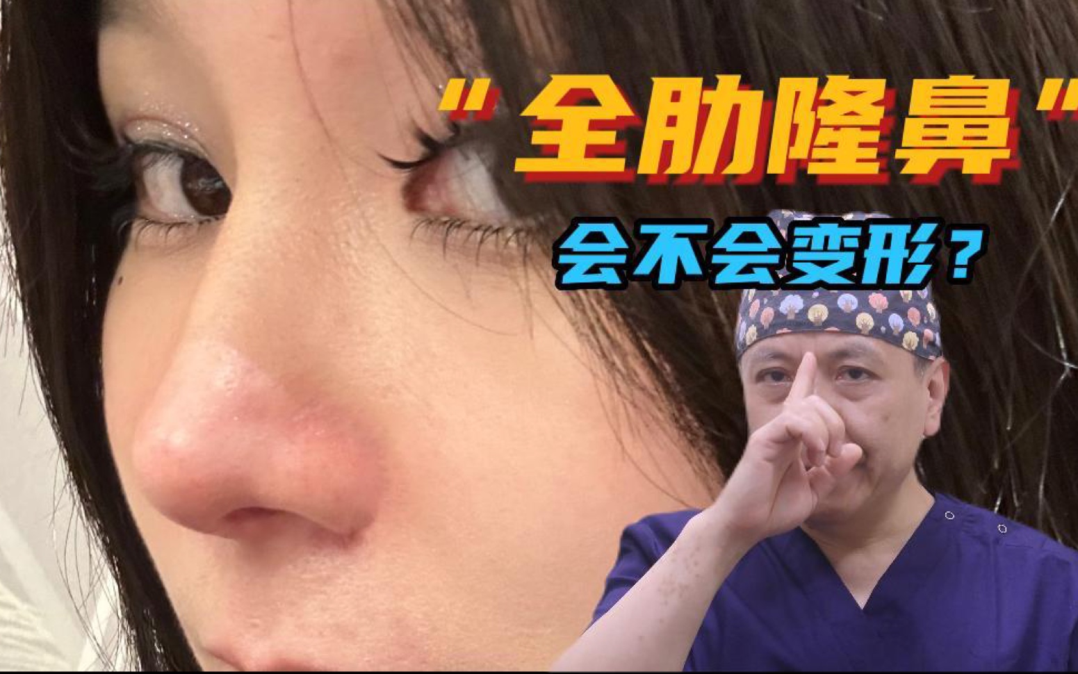 全肋软骨隆鼻,到底会不会变形? #肋骨鼻颠覆你的美 #鼻子 #变美