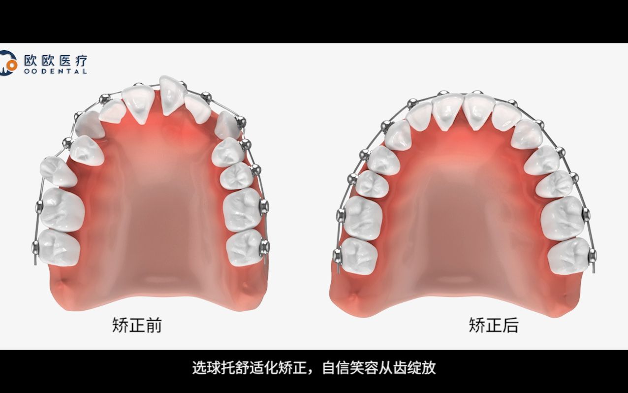 【产品说】球面自锁托槽是如何矫正牙齿的呢?怎么做到又快又舒适矫正牙齿?哔哩哔哩bilibili