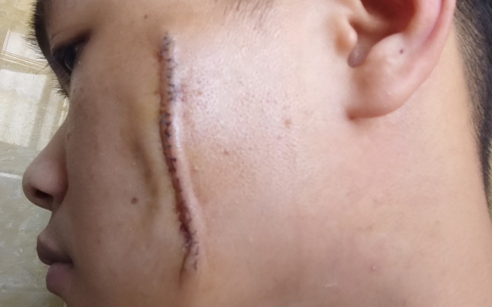 皮脂腺痣术后第六天,换纱布_哔哩哔哩_bilibili