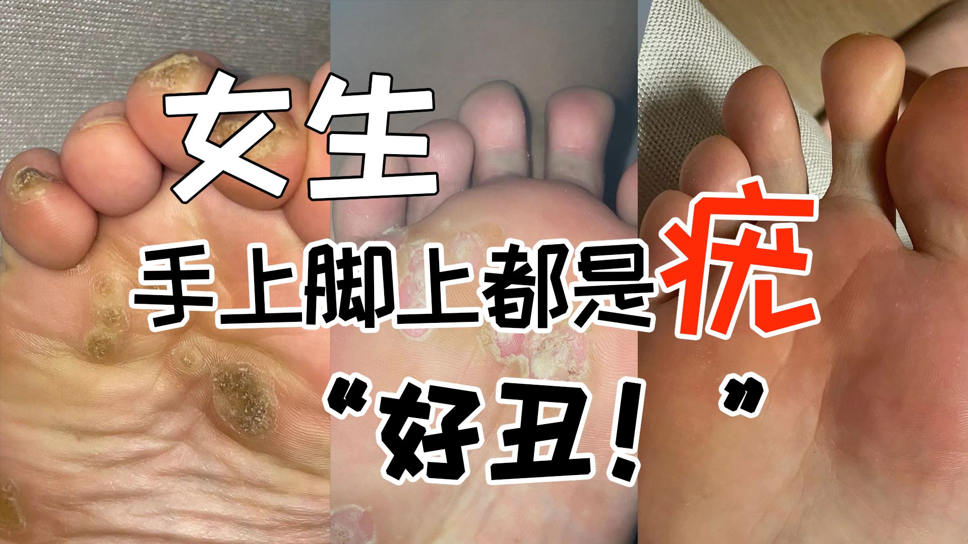 跖疣扩散从脚上到手上,从一颗变多颗,今天让病毒彻底