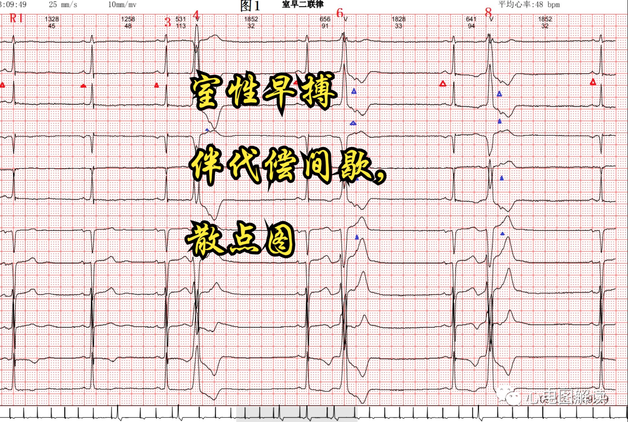 室性早搏三联律心电图图片