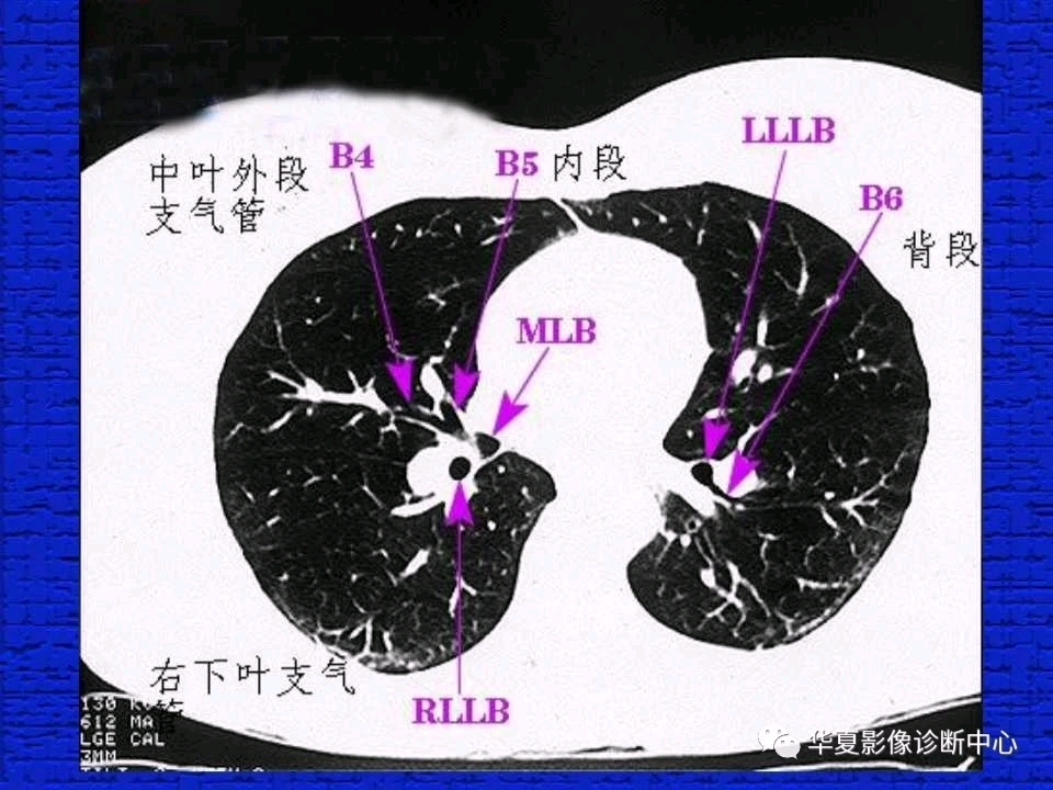 肺部CT分段解剖哔哩哔哩bilibili