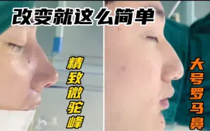 Download Video: 男孩子鼻子高大也是烦恼？微驼峰了解一下！