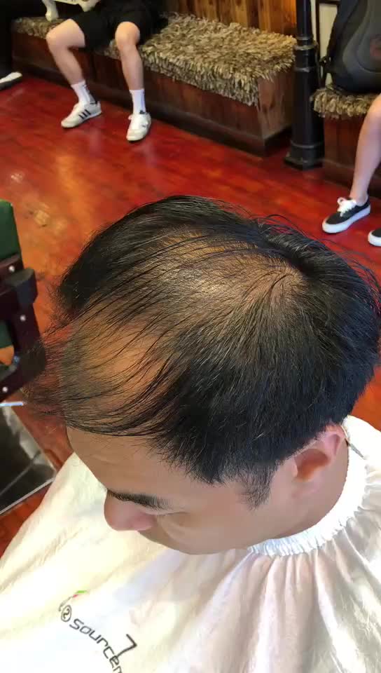 90后作为脱发的第一批大军你们有这个补发神器吗