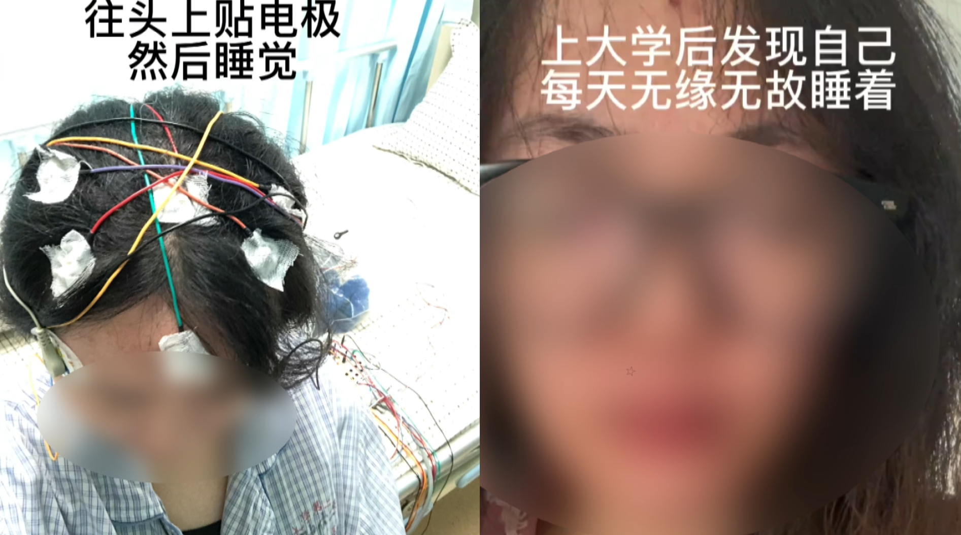 女生总是无缘无故睡着,就医后被确诊发作性睡病,医生:属罕见病哔哩哔哩bilibili