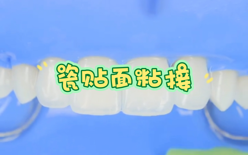 瓷贴面粘结流程哔哩哔哩bilibili