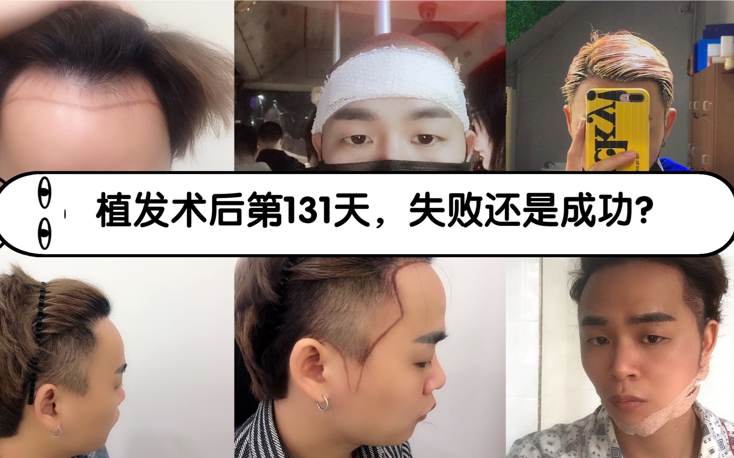 植发群体中90后(第一批90后开始植发)