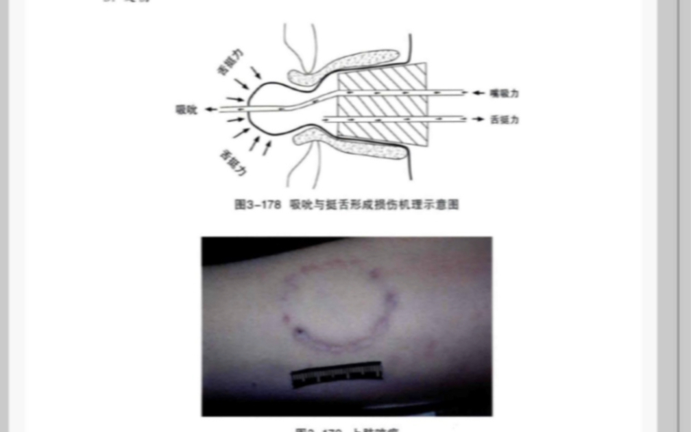 [图]尸变图鉴大合集之新法医学图谱私