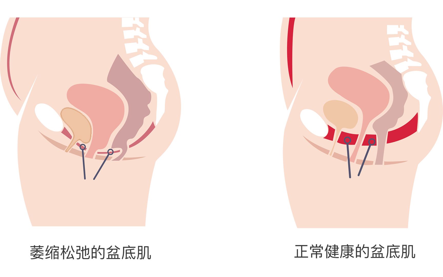 认识盆底肌哔哩哔哩bilibili