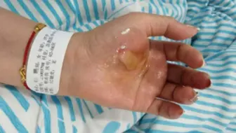 35岁女子家中洗澡疑热水器漏电，心脏骤停侥幸获救：手掌有烫痕，眼眶布满血丝