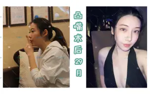 Download Video: 中度骨性凸嘴，下巴后缩，术后2年5个月~