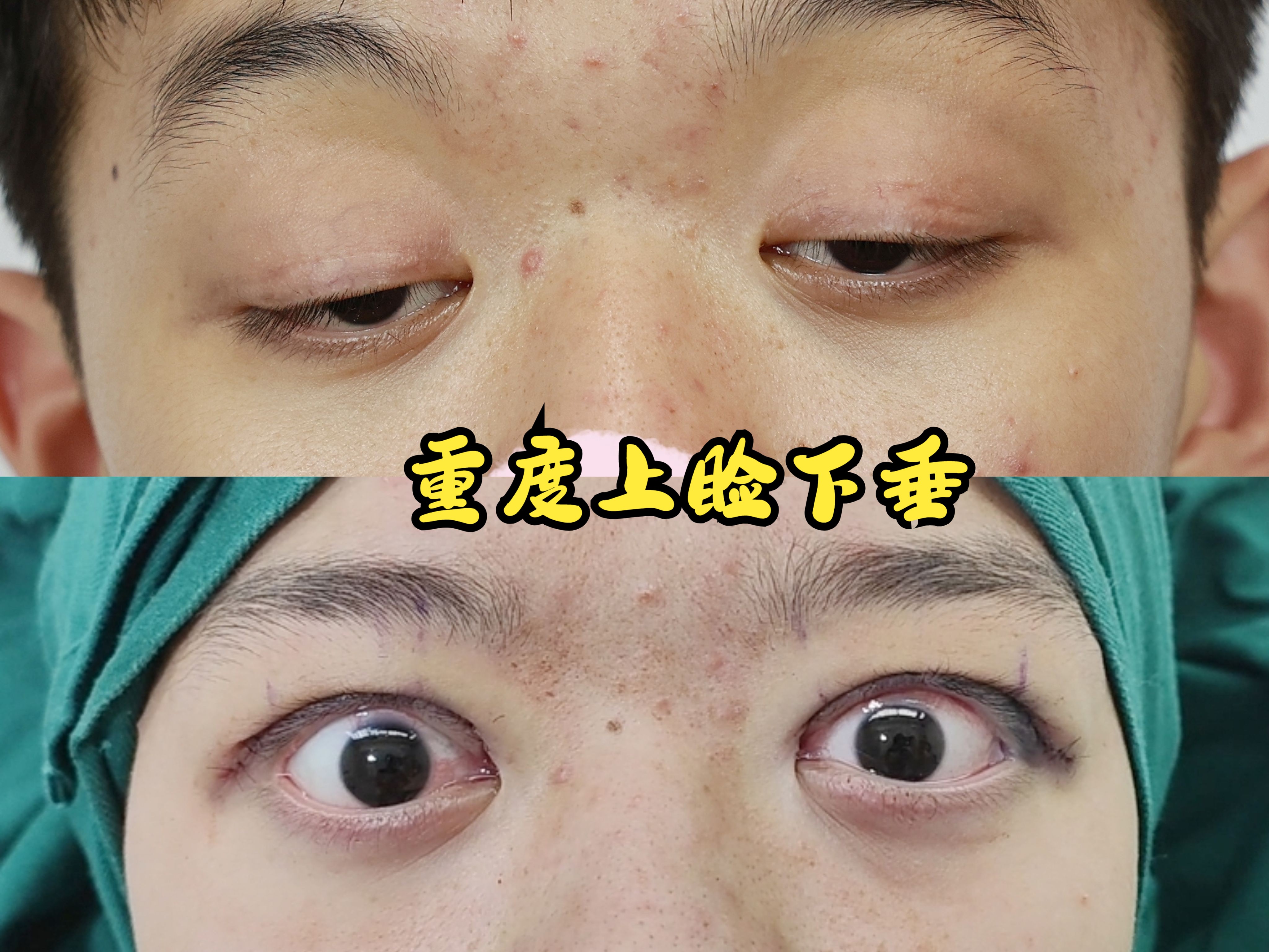 复杂性上睑下垂复发后修复,看下这次的修复效果.