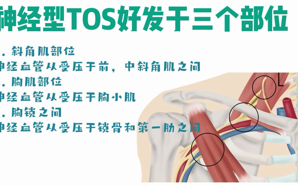 胸廓出口综合征TOS的发病原理及测试方法哔哩哔哩bilibili