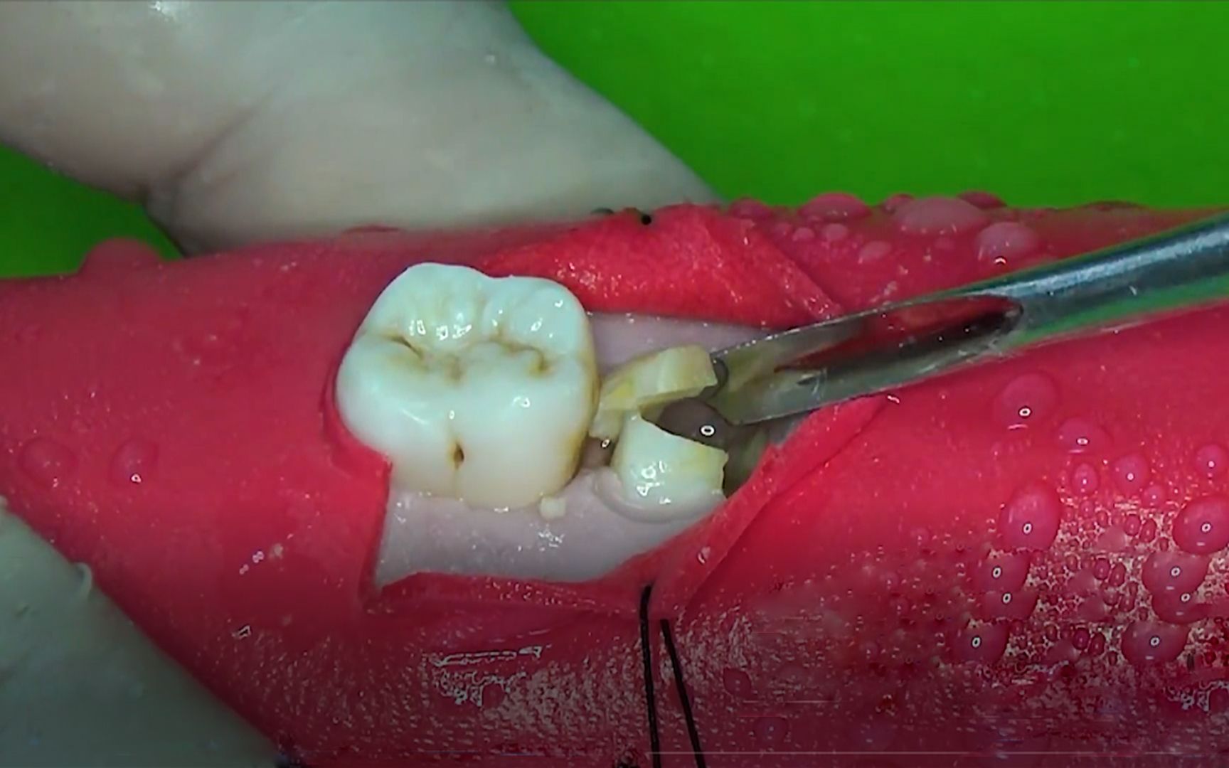 智齿完全埋在了牙龈里,用电钻把牙龈切开,才知道里面这么可怕!