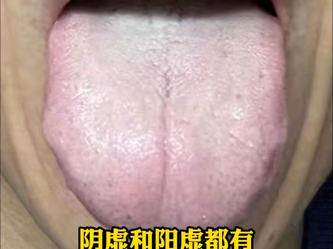 舌头淡胖,有裂纹,舌苔白腻,中医会怎么辩证?