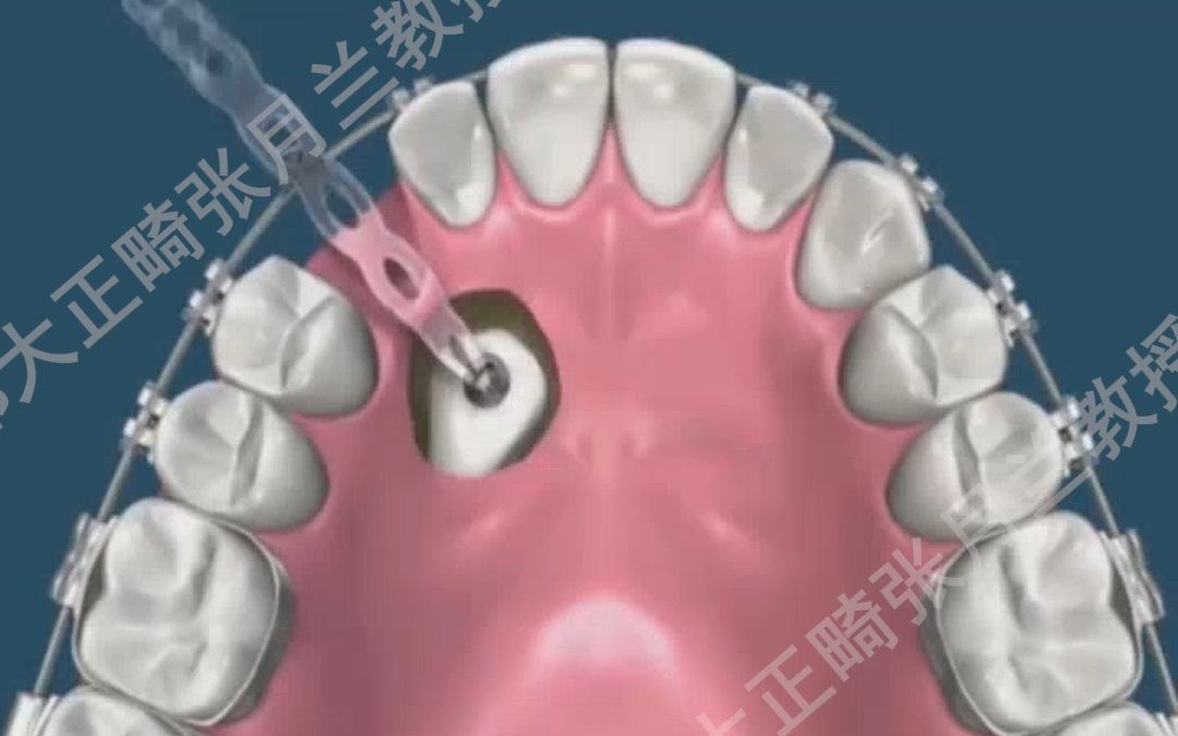 [图]藏在肉里的牙齿也能矫正，是不是很神奇？