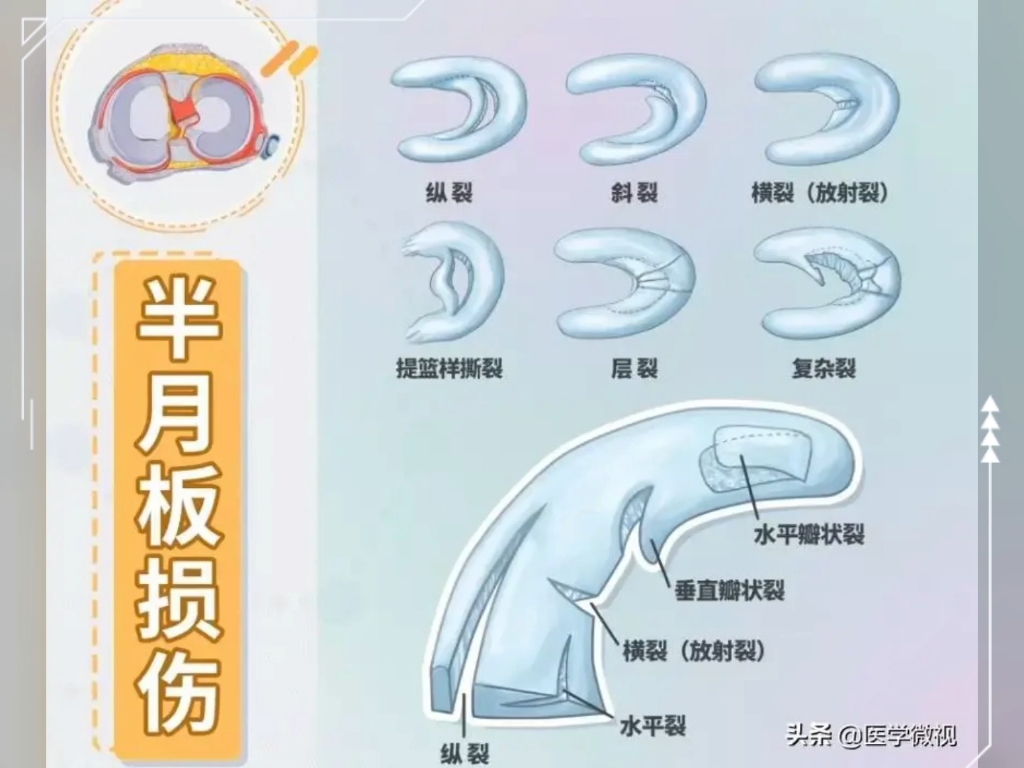 半月板损伤运动康复