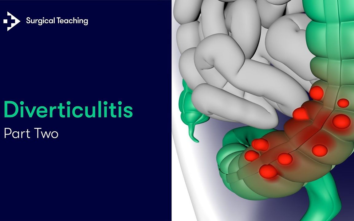 憩室炎第 2 部分 | 有多常见以及患者出现什么症状?哔哩哔哩bilibili