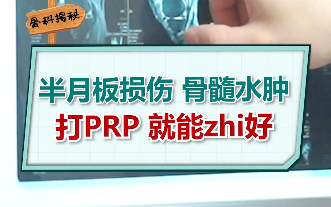 半月板损伤,骨髓水肿,可以打PRP治疗哔哩哔哩bilibili