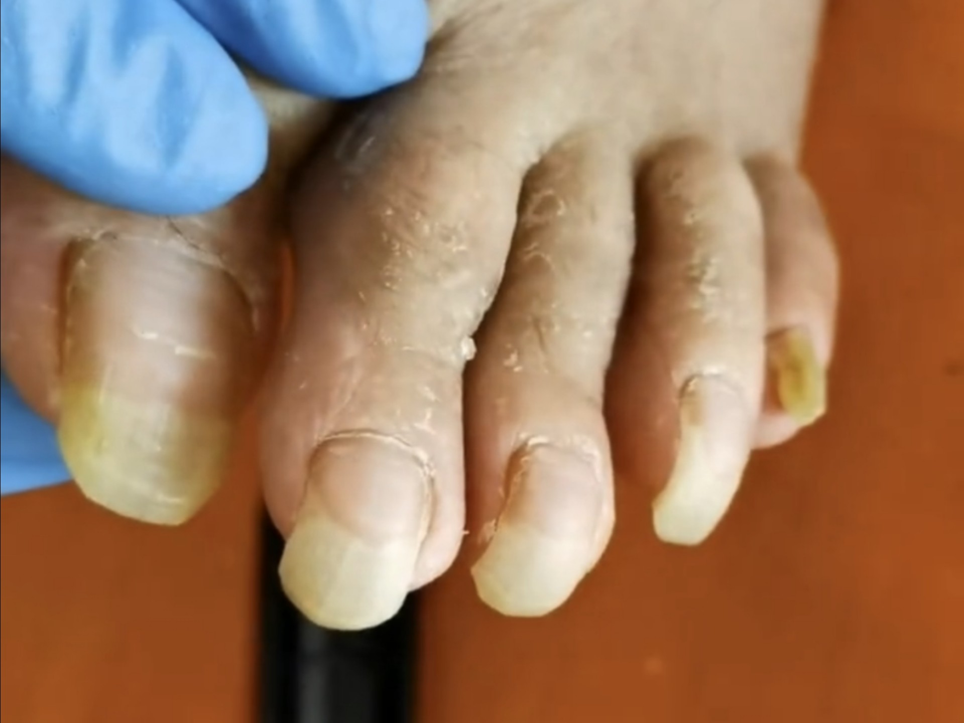 养老院的老人脚趾甲有点长