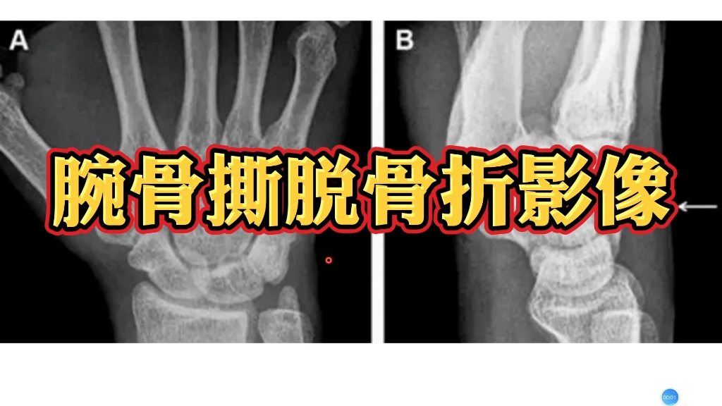 三角骨撕脱骨折X线影像,简单易懂,别在误诊了!哔哩哔哩bilibili