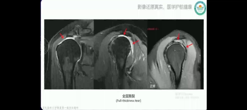 冈上肌肌腱撕裂哔哩哔哩bilibili