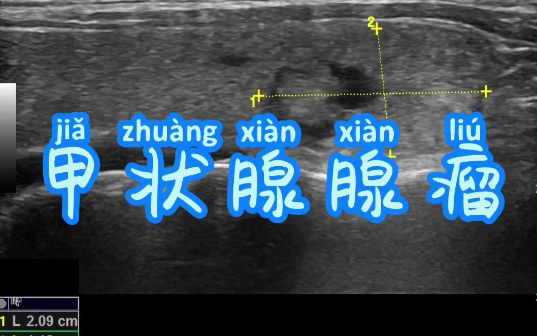 甲状腺腺瘤哔哩哔哩bilibili