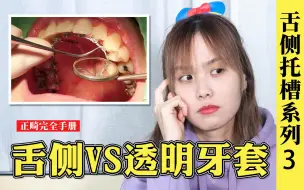 Download Video: 6万块的舌侧牙套PK5万块的透明牙套，隐形正畸选哪个？