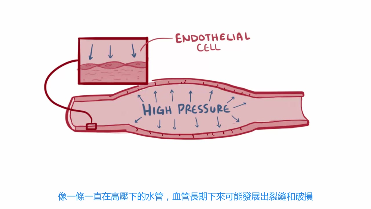 高血压的解释,wikipedia哔哩哔哩bilibili