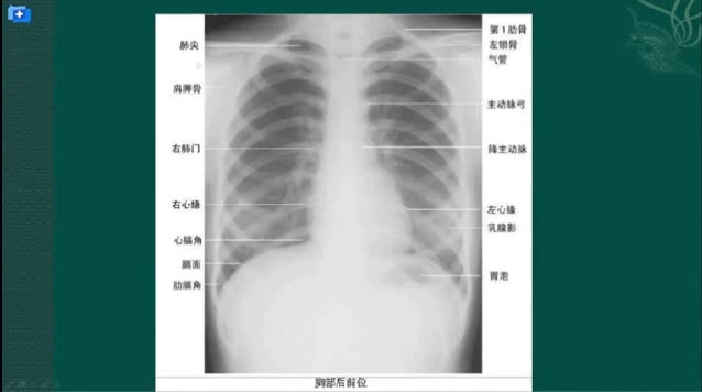 [图]刘敏:胸片的基础